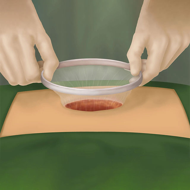 Weight Loss Disposable Medical Grade Incision Sleeve