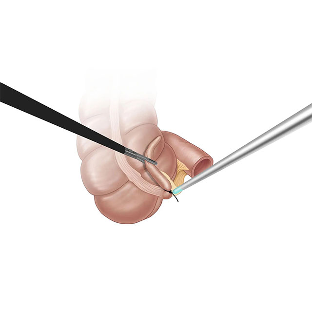 Endoscopic Non-Absorbable Plastic Ligation Loop